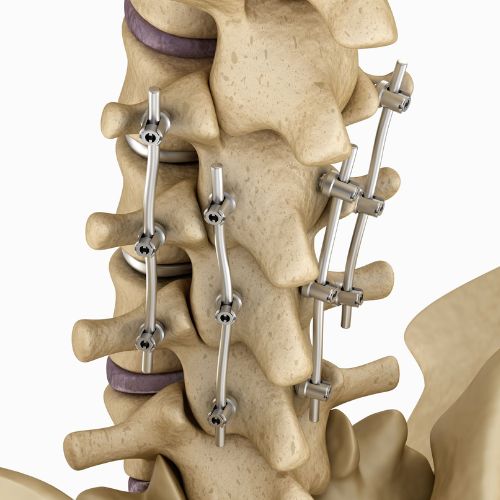 Chronic neck or back pain